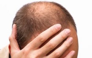 Baldness cure: Orally administered drugs and topically applied medication for hair loss