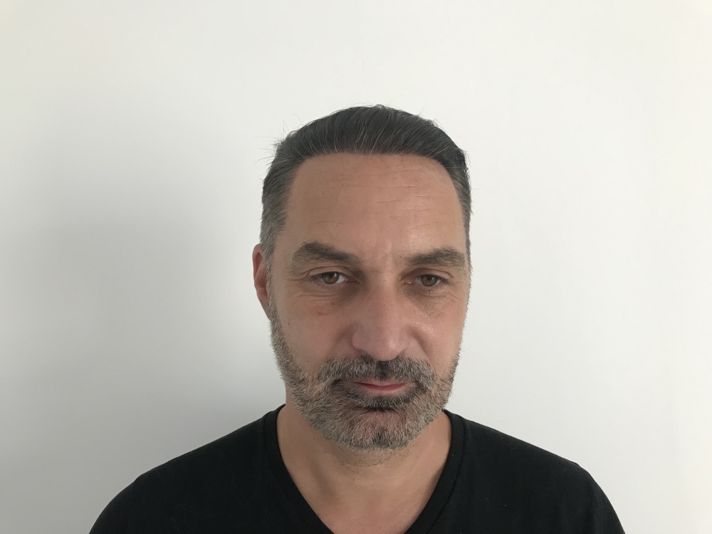 One year after hair restoration in Budapest, Hungary